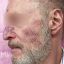 Проявления купероза на лице: лечение заболевания в клинике Телос Бьюти проф.