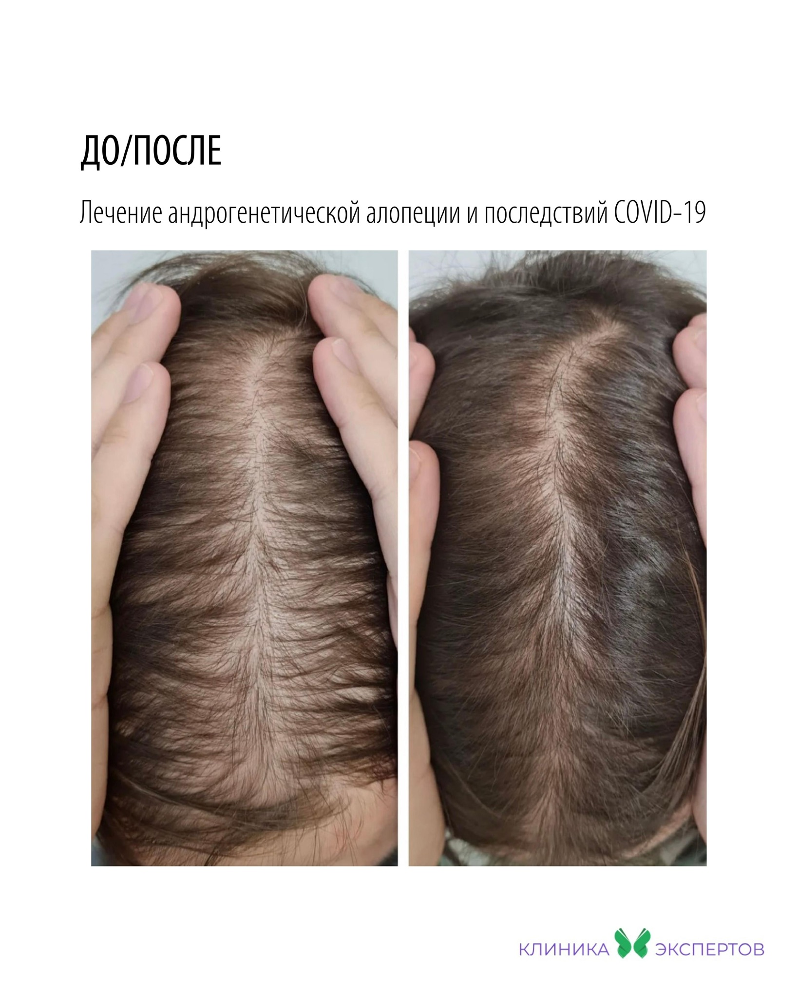 Лечение выпадения волос в Телос Бьюти проф.